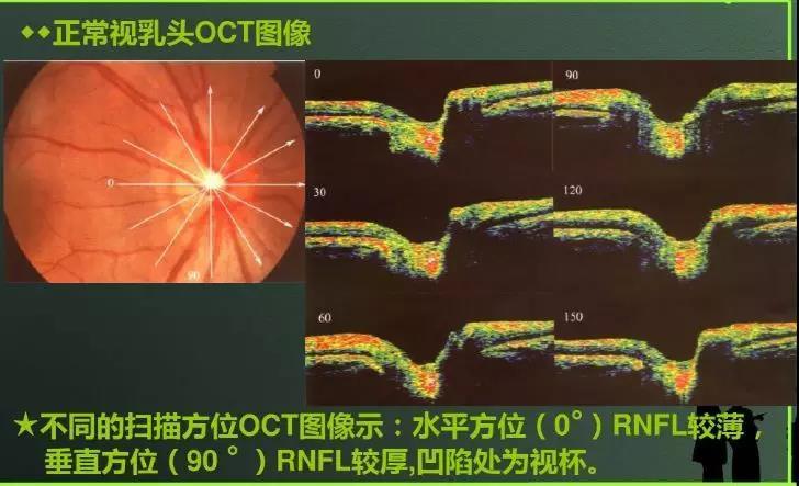 眼科欧堡检查是OCT吗